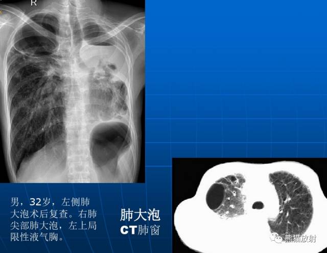肺气肿的“千姿百态”! 肺气肿的“千姿百态”!