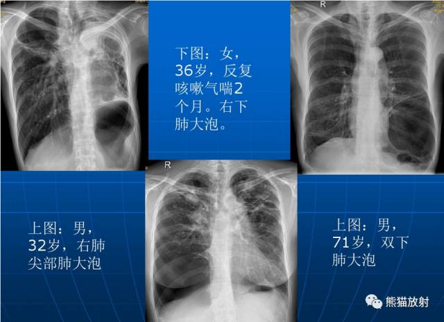 肺气肿的“千姿百态”! 肺气肿的“千姿百态”!