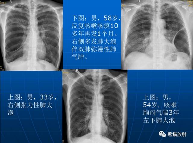 肺气肿的“千姿百态”! 肺气肿的“千姿百态”!