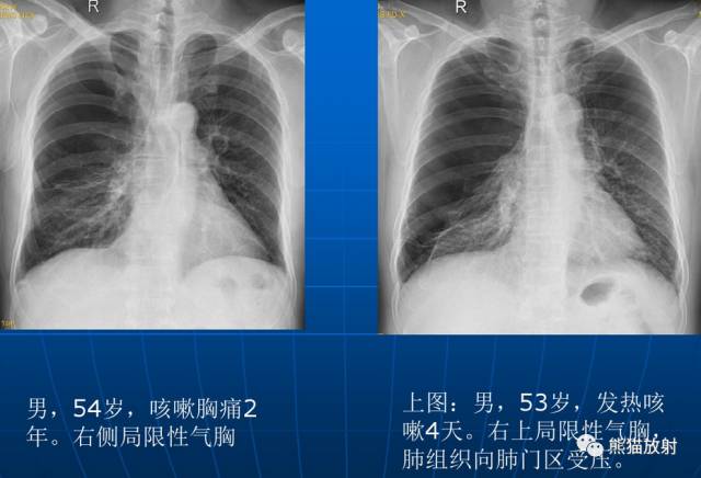 肺气肿的“千姿百态”! 肺气肿的“千姿百态”!