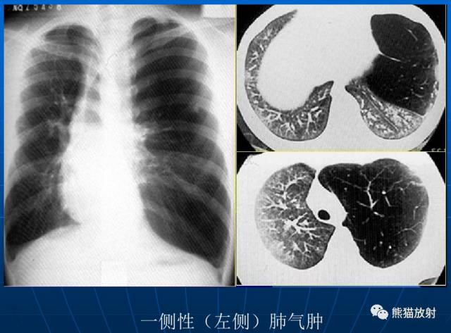 肺气肿的“千姿百态”! 肺气肿的“千姿百态”!
