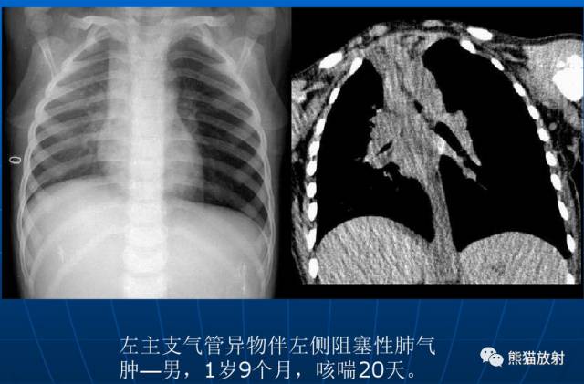 肺气肿的“千姿百态”! 肺气肿的“千姿百态”!