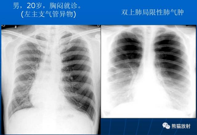 肺气肿的“千姿百态”! 肺气肿的“千姿百态”!