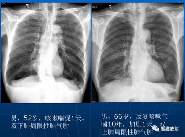 肺气肿的“千姿百态”! 肺气肿的“千姿百态”!