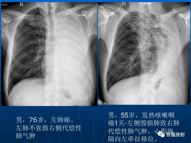 肺气肿的“千姿百态”! 肺气肿的“千姿百态”!