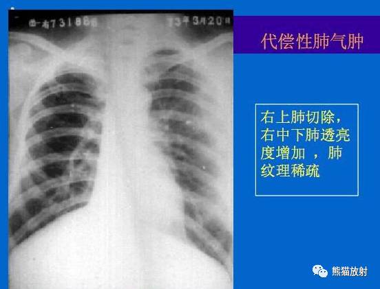 肺气肿的“千姿百态”! 肺气肿的“千姿百态”!