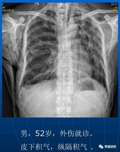 肺气肿的“千姿百态”! 肺气肿的“千姿百态”!