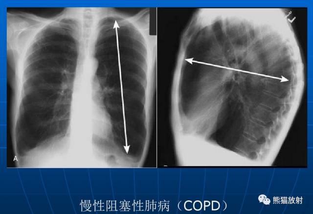 肺气肿的“千姿百态”! 肺气肿的“千姿百态”!