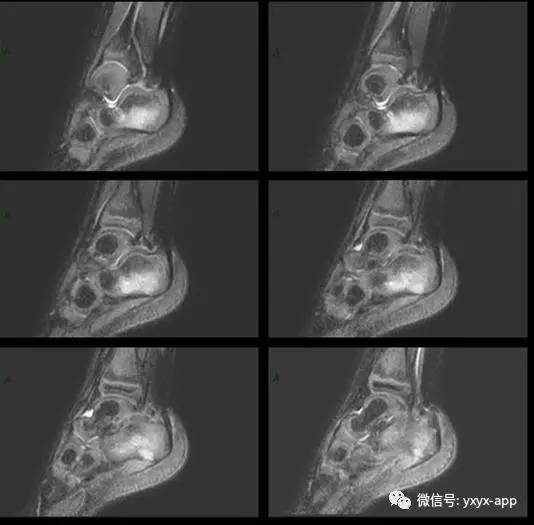 【病例】跟骨骨母细胞瘤1例CT及MR影像表现 【病例】跟骨骨母细胞瘤1例CT及MR影像表现