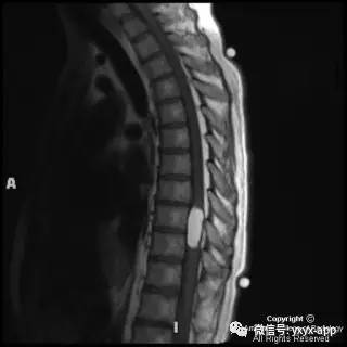 【病例】髓内脂肪瘤1例MRI影像诊断分析 【病例】髓内脂肪瘤1例MRI影像诊断分析