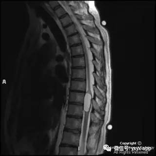 【病例】髓内脂肪瘤1例MRI影像诊断分析 【病例】髓内脂肪瘤1例MRI影像诊断分析