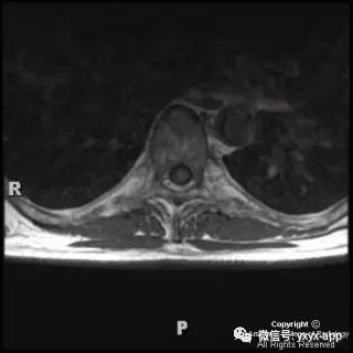 【病例】髓内脂肪瘤1例MRI影像诊断分析 【病例】髓内脂肪瘤1例MRI影像诊断分析