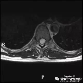 【病例】髓内脂肪瘤1例MRI影像诊断分析 【病例】髓内脂肪瘤1例MRI影像诊断分析