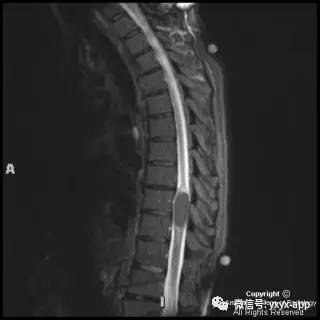 【病例】髓内脂肪瘤1例MRI影像诊断分析 【病例】髓内脂肪瘤1例MRI影像诊断分析