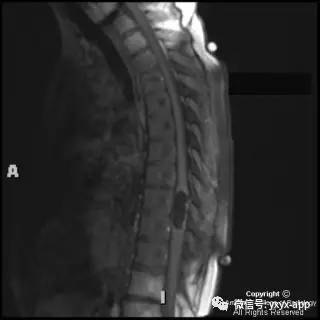 【病例】髓内脂肪瘤1例MRI影像诊断分析 【病例】髓内脂肪瘤1例MRI影像诊断分析