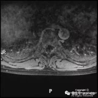 【病例】髓内脂肪瘤1例MRI影像诊断分析 【病例】髓内脂肪瘤1例MRI影像诊断分析