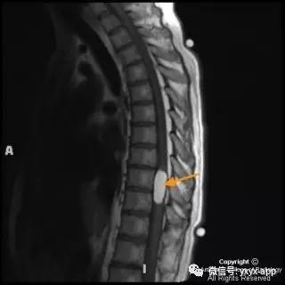 【病例】髓内脂肪瘤1例MRI影像诊断分析