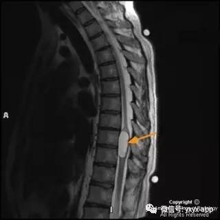 【病例】髓内脂肪瘤1例MRI影像诊断分析 【病例】髓内脂肪瘤1例MRI影像诊断分析