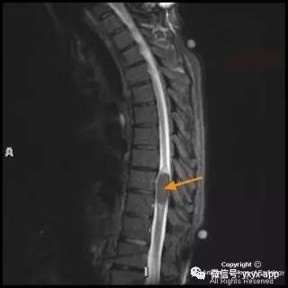 【病例】髓内脂肪瘤1例MRI影像诊断分析 【病例】髓内脂肪瘤1例MRI影像诊断分析