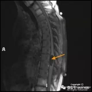 【病例】髓内脂肪瘤1例MRI影像诊断分析 【病例】髓内脂肪瘤1例MRI影像诊断分析