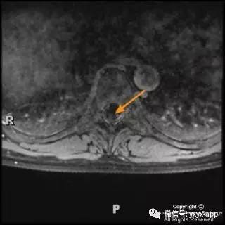 【病例】髓内脂肪瘤1例MRI影像诊断分析 【病例】髓内脂肪瘤1例MRI影像诊断分析
