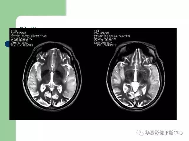 【PPT】颅内对称性病变的诊断