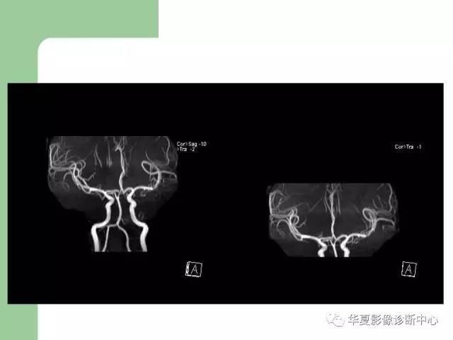 【PPT】颅内对称性病变的诊断