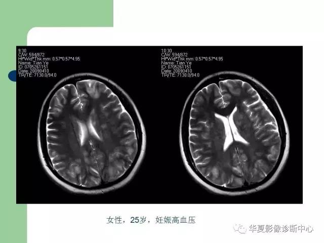 【PPT】颅内对称性病变的诊断