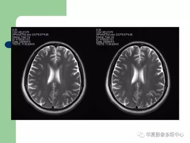 【PPT】颅内对称性病变的诊断