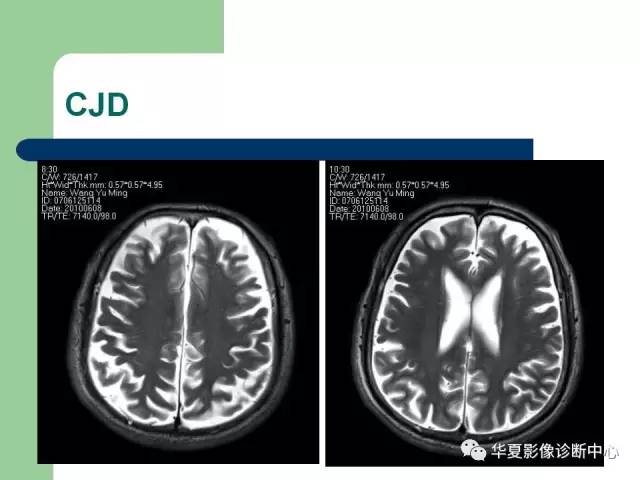 【PPT】颅内对称性病变的诊断