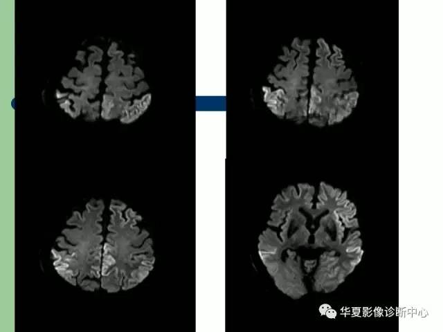 【PPT】颅内对称性病变的诊断