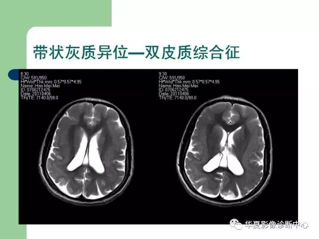 【PPT】颅内对称性病变的诊断