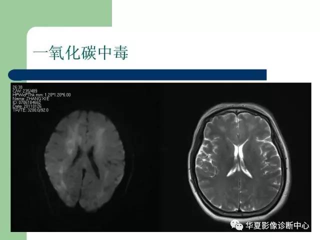 【PPT】颅内对称性病变的诊断