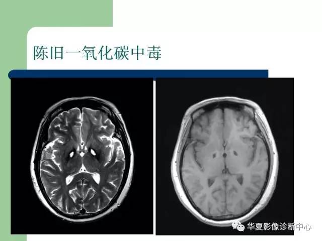 【PPT】颅内对称性病变的诊断