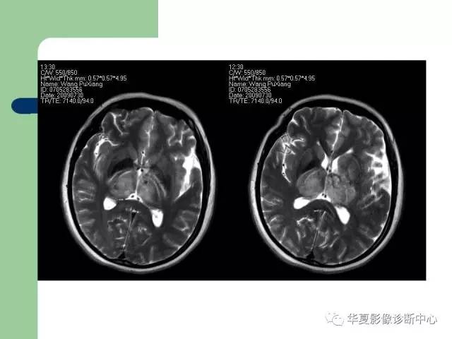 【PPT】颅内对称性病变的诊断