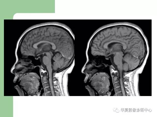 【PPT】颅内对称性病变的诊断