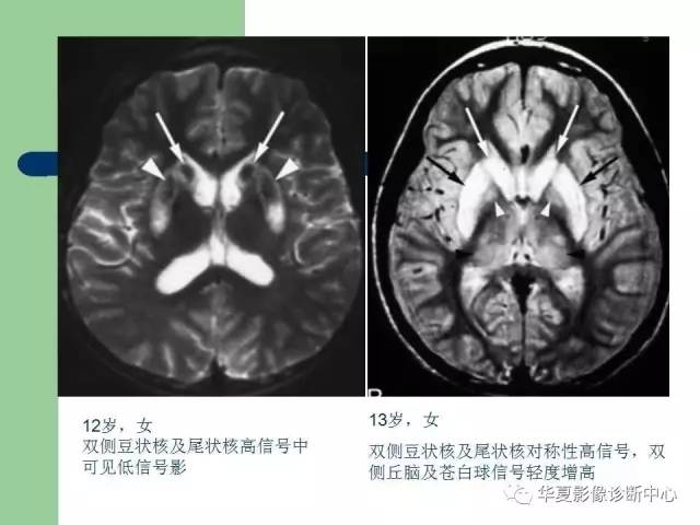 【PPT】颅内对称性病变的诊断