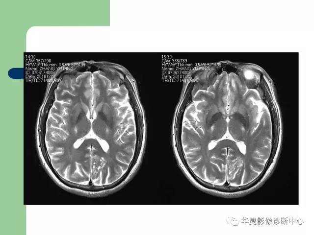 【PPT】颅内对称性病变的诊断