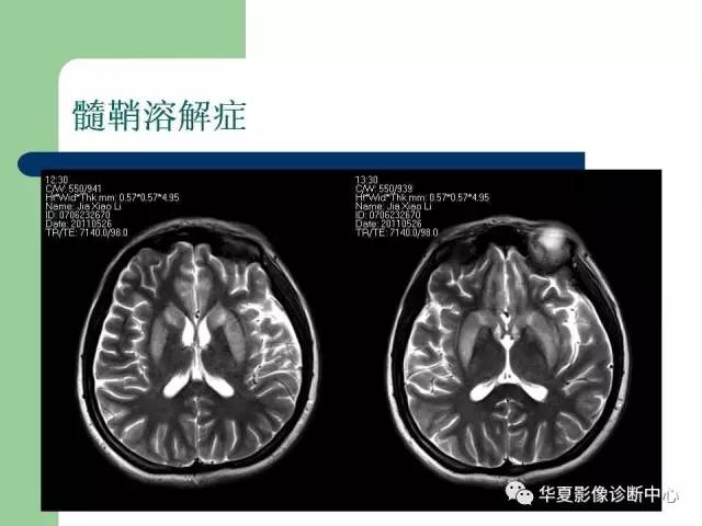 【PPT】颅内对称性病变的诊断