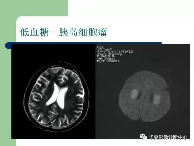 【PPT】颅内对称性病变的诊断