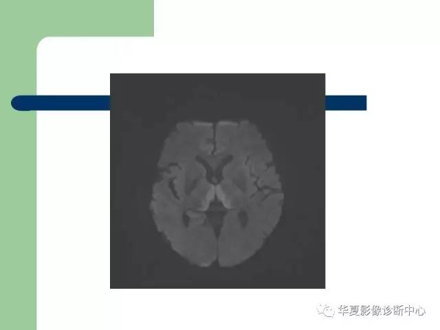【PPT】颅内对称性病变的诊断