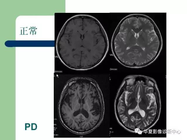 【PPT】颅内对称性病变的诊断