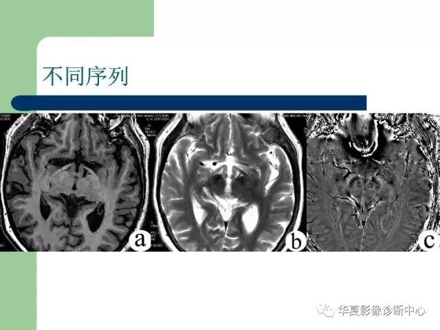 【PPT】颅内对称性病变的诊断