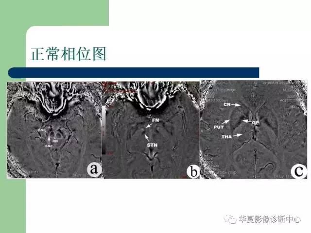 【PPT】颅内对称性病变的诊断