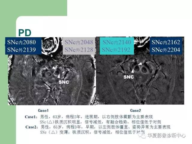 【PPT】颅内对称性病变的诊断