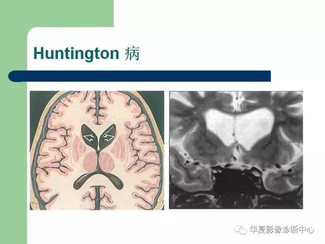【PPT】颅内对称性病变的诊断
