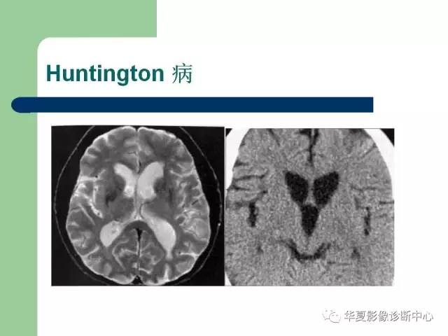 【PPT】颅内对称性病变的诊断