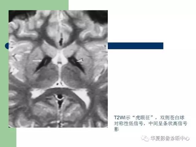 【PPT】颅内对称性病变的诊断
