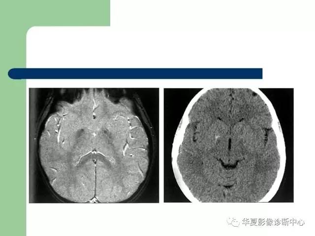 【PPT】颅内对称性病变的诊断