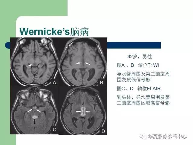 【PPT】颅内对称性病变的诊断